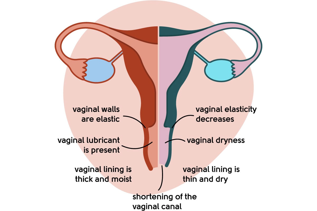 Menopause